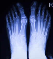 Foot and toes injury xray scan