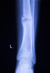 Forearm arm and elbow xray scan