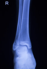 Shin leg ankle injury xray scan