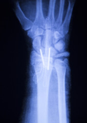 Forearm orthopedic implant xray scan