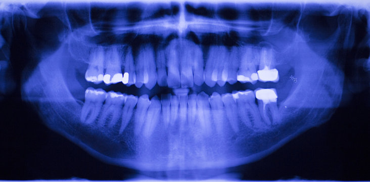 Dental teeth filling dentists xray scan