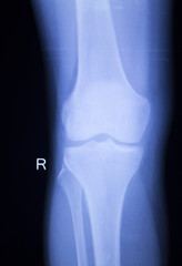 Knee and meniscus injury xray scan