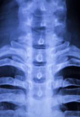 Spine vertebra back injury xray scan