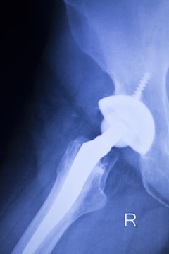 Hip joint orthopedic replacement implant