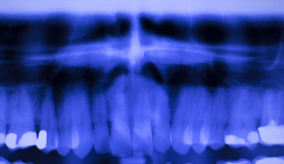Dental teeth filling dentists xray scan