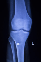 Knee injury screw implant xray scan