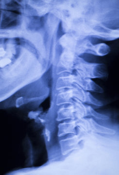 Skull neck spine shoulders xray scan