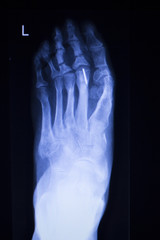 Foot and toes injury xray scan