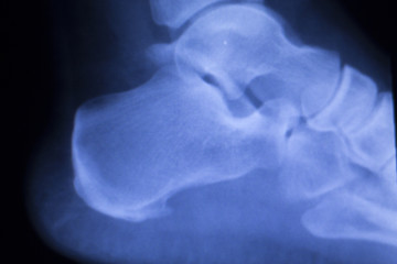 Foot heel ankle injury xray scan