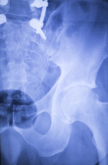 Hip replacement xray orthopedic medical scan