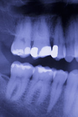 Dental teeth filling dentists xray scan