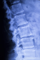 Spine vertebra back injury xray scan