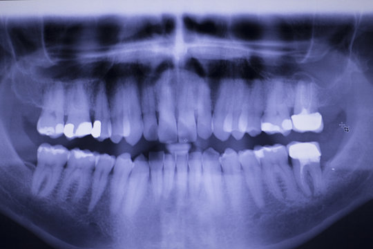 Dental teeth filling dentists xray scan