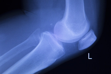 Knee and meniscus injury xray scan
