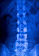 Spine vertebra back injury xray scan
