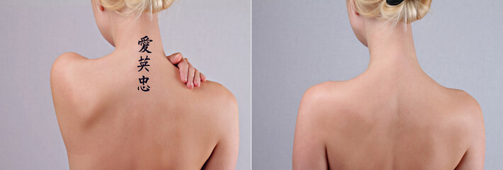 Laser tattoo removal before and after. Beautiful young woman with tattoo on her back