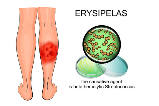 erysipelas of the lower leg