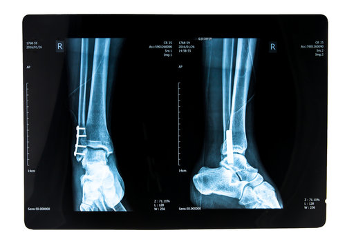 human foot right ankel xray picture with plate and screws