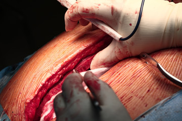 Surgical cutting of the human sternum macro