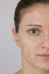 Fototapeta premium Beautiful young girl with acne on his face and the back on a whi