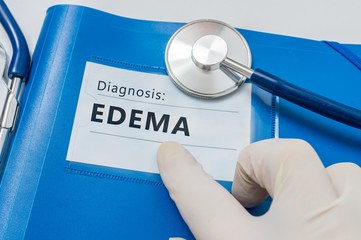 Edema - lymphatic diagnosis on blue folder with stethoscope.