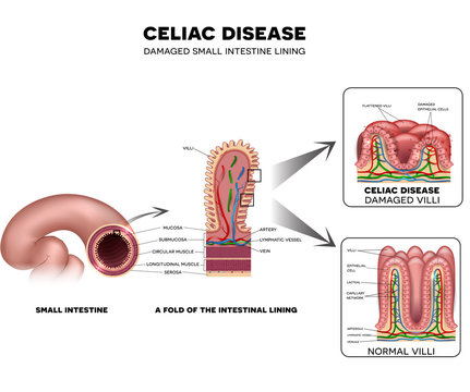 Celiac disease Small intestine lining damage. Healthy villi and damaged villi. Small intestine, a fold of the intestinal lining and villi.