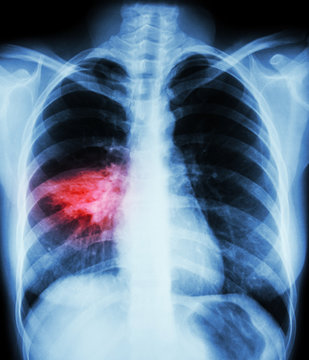 Pneumonia ( film chest x-ray show alveolar infiltrate at right middle lung ) ( image for pulmonary tuberculosis , Mers-CoV , SARS )