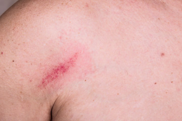 Minor bruise on skin between shoulder and chest