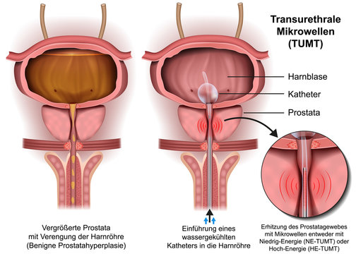 Transurethrale Mikrowellen TUMT Illustration, Prostata operation