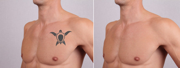 Laser tattoo removal before and after. Attractive Man with tattoo on his chest