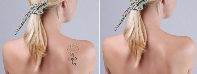 Laser tattoo removal before and after. Beautiful young woman with tattoo on her back