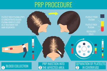 Platelet rich plasma injection. PRP therapy process. Female hair loss treatment infographics. Injection. Meso therapy. Hair growth stimulation. Vector illustration.