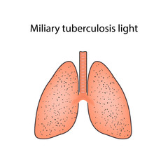 Miliary tuberculosis. Vector illustration on isolated background