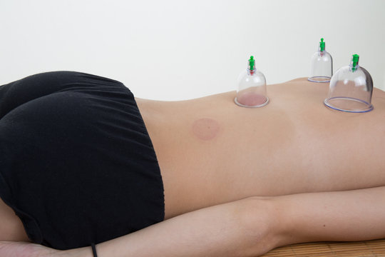 Multiple Vacuum Cup Of Medical Cupping Therapy On Human Body