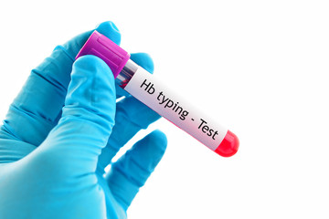 Obraz premium Blood sample for hemoglobin (Hb) typing test, thalassemia diagnosis 