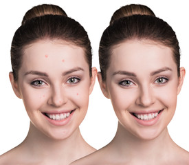 Woman with problem skin on her face