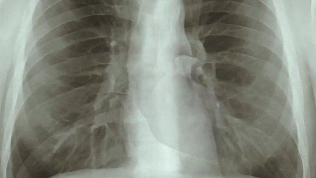 Chest x-ray scan from top to bottom. (loop ready animation)