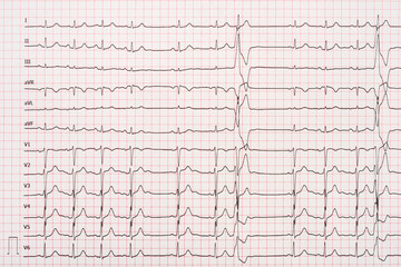 Extrasystole On 12 Lead Electrocardiogram Record Paper