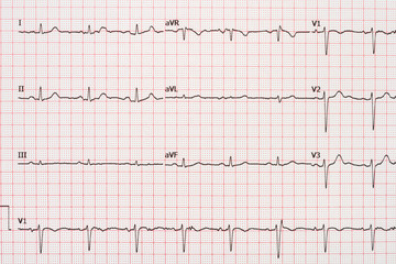 Extrasystole On 12 Lead Electrocardiogram Record Paper