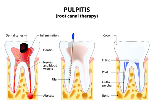 Pulpitis. root canal therapy