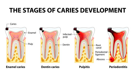 stages of caries development