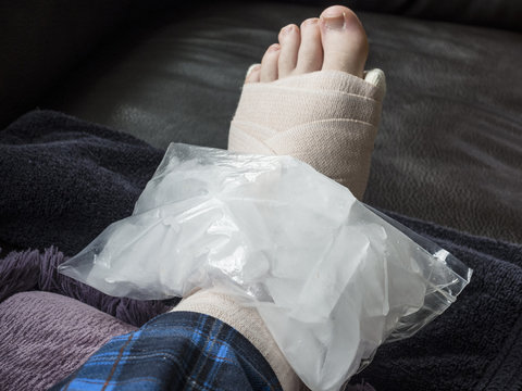 Icing Broken, Fractured or Sprained Foot or Ankle in Cast or Compression Wrap
