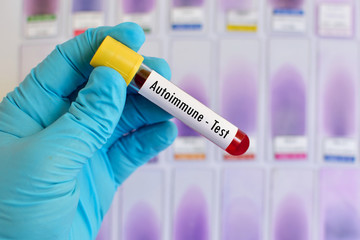 Blood sample for autoimmune disease test
