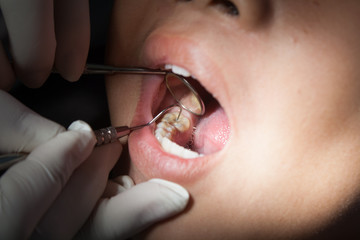Dentist holding mirror dental treatment, dental sealants.