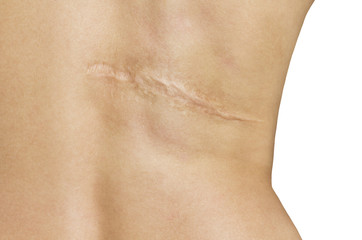 Scar after operation on back of women on white background - obrazy, fototapety, plakaty
