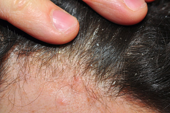 Itchy hair skin, dandruff psoriasis trouble
