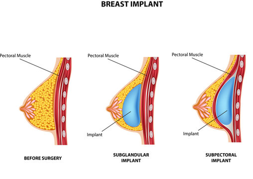Illustration of Plastic surgery of breast implant
