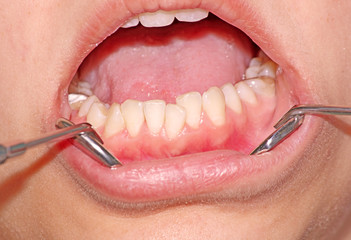 Malocclusion. Crowding of the teeth