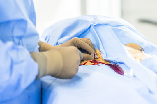 Interventional radiology, surgeon using guide wire