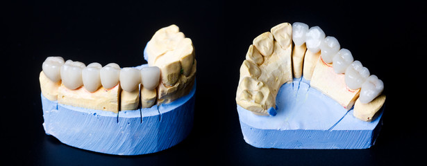 Prótesis fija dental 